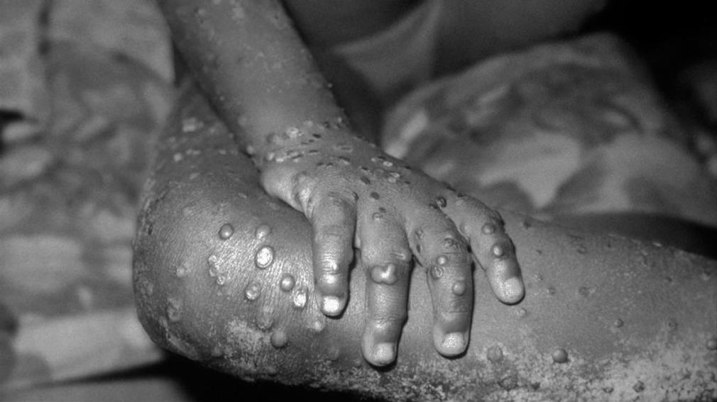Científicos africanos desconcertados por como se propagó enfermedad fuera del continente