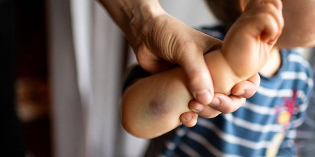 Aberrante, un bebe se encuentra en terapia intensiva tras una brutal golpiza, arrestaron a su padre y a su tía